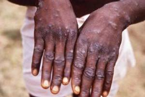 بیماری نادر مانکی پاکس