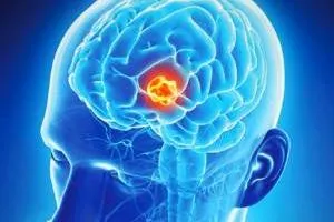 علائم تومور مغزی
