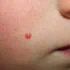 خال قرمز روی پوست