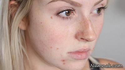 کرم درمان لک های پوستی