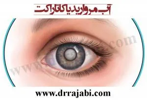 آب مروارید