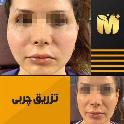 تزریق چربی به صورت