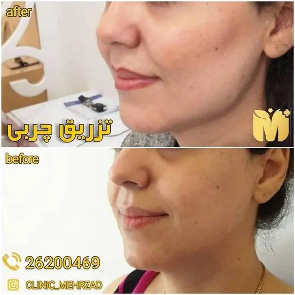تزریق چربی