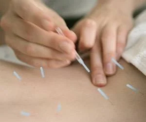 طب سوزنی