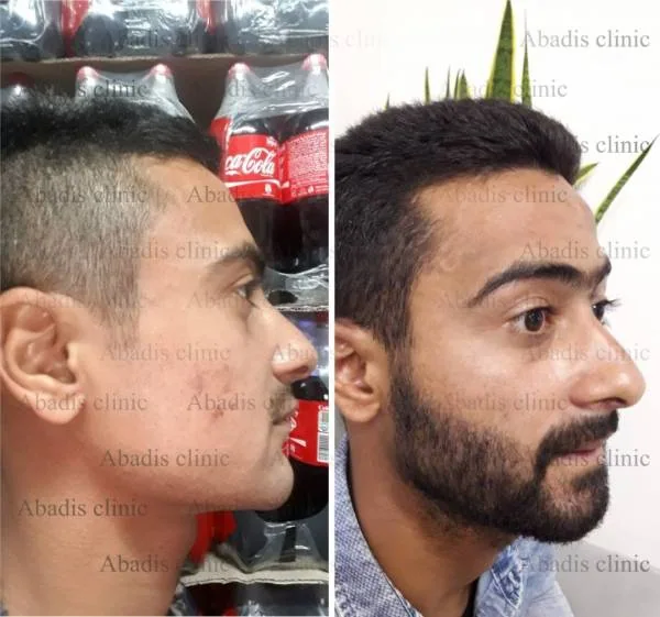 کاشت ریش