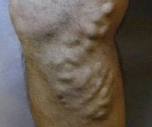 واریس پا