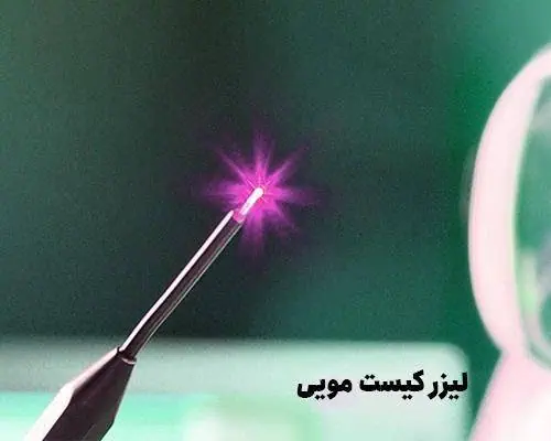 لیزر کیست مویی