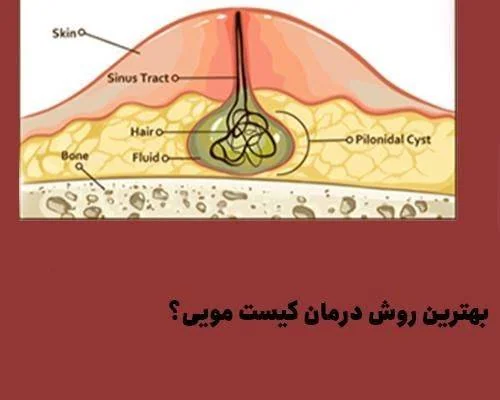 بهترین روش درمان کیست مویی
