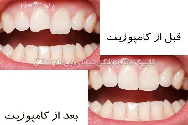 کامپوزیت دندان
