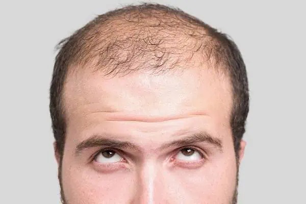 عوارض خطرناک کاشت مو