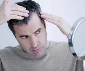 ریزش مو