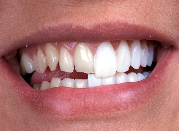 تاثیر ارتودنسی روی دندان