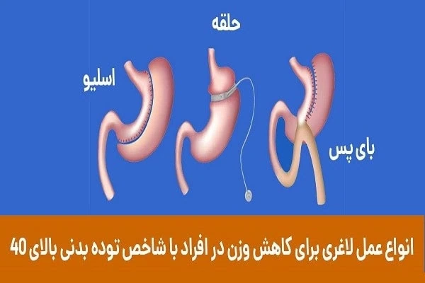 انواع عمل معده