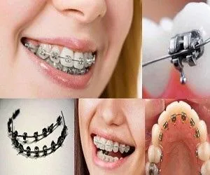 بریس ارتودنسی