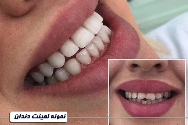 لمینیت دندان