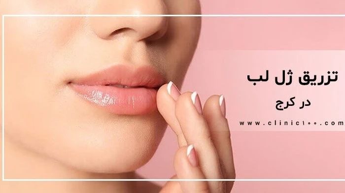 تزریق ژل لب