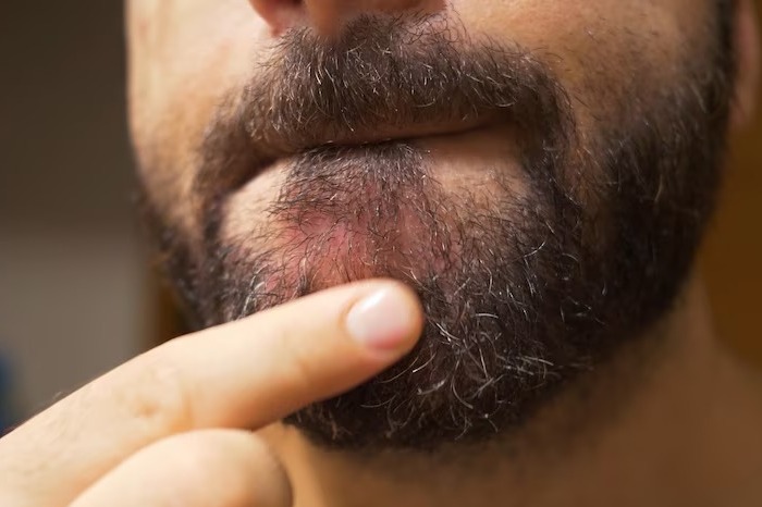 فولیکولیتیس از باشگاه فولیکولیتیس