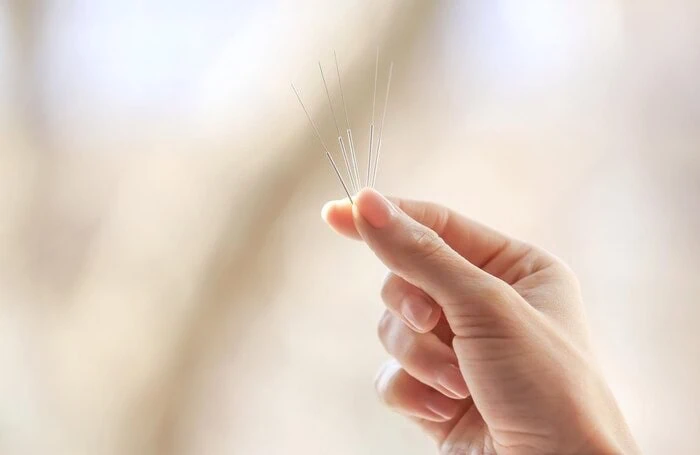 لاغری با طب سوزنی