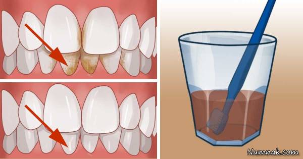 سفیدکردن دندان با سرکه