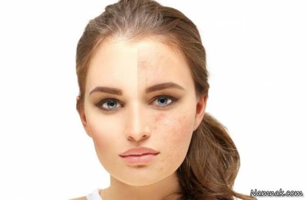 جلوگیری از لک شدن پوست