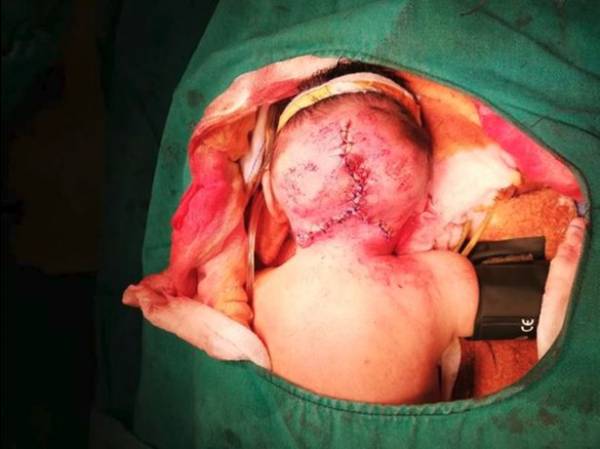 جراحی نوزاد دو سر