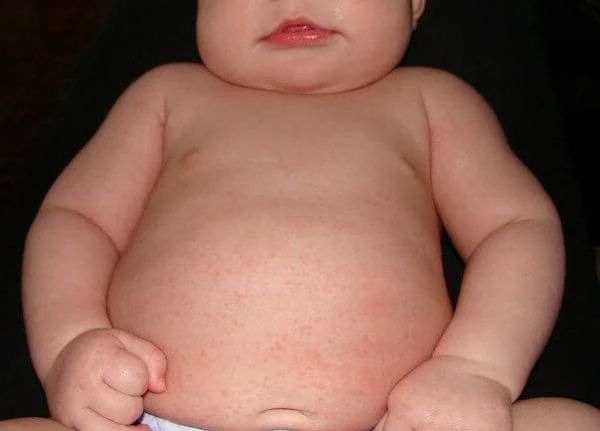 علل گرمازدگی