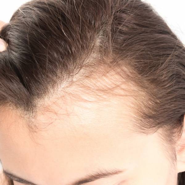 ریزش موی شقیقه در زنان