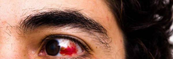 درمان خونریزی زیر ملتحمه چشم 
