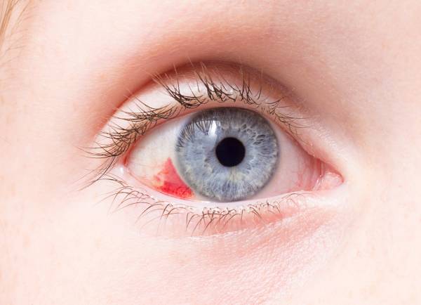 علت لکه خون در چشم
