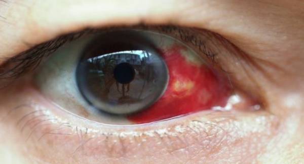 علل لکه خون در چشم