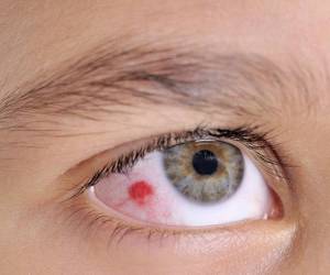 درمان لکه خون در چشم