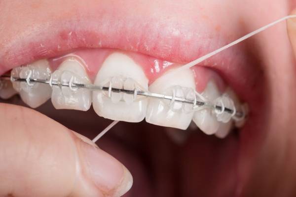 مراقبت از دندان ارتودنسی