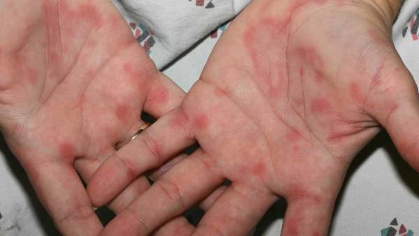 نشانه های قلبی اندوکاردیت