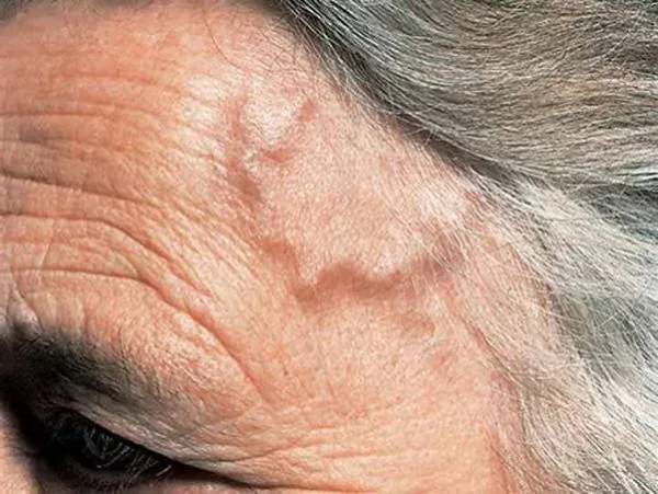 برجستگی رگهای شقیقه