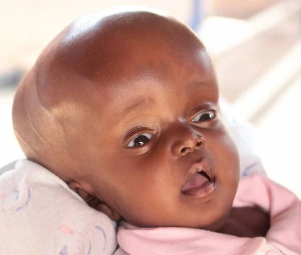 hydrocephalus disease