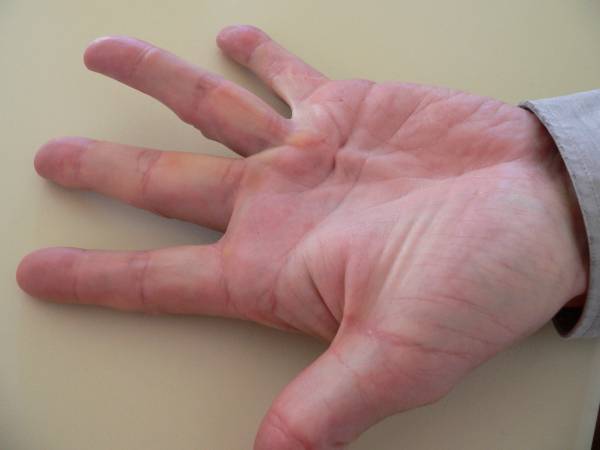  Dupuytren's contracture