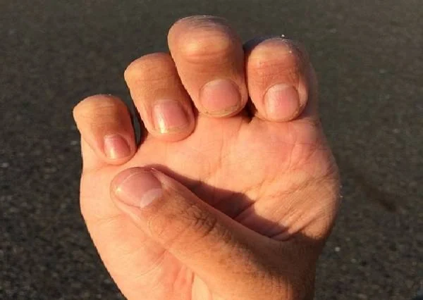 تغییرات ناخن