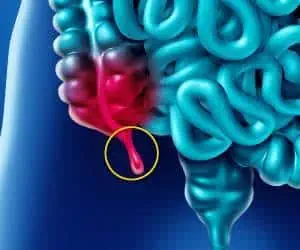 فواید آپاندیس