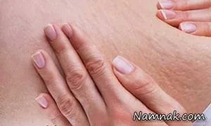 ترک های پوستی
