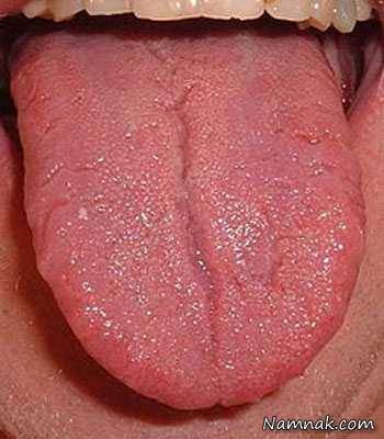 سوختگي زبان 