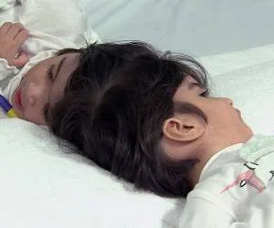 دوقلوی بهم چسبیده