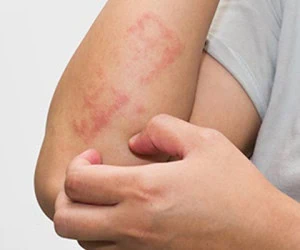  کنترل اگزمای بدن و صورت با چند روش ساده 