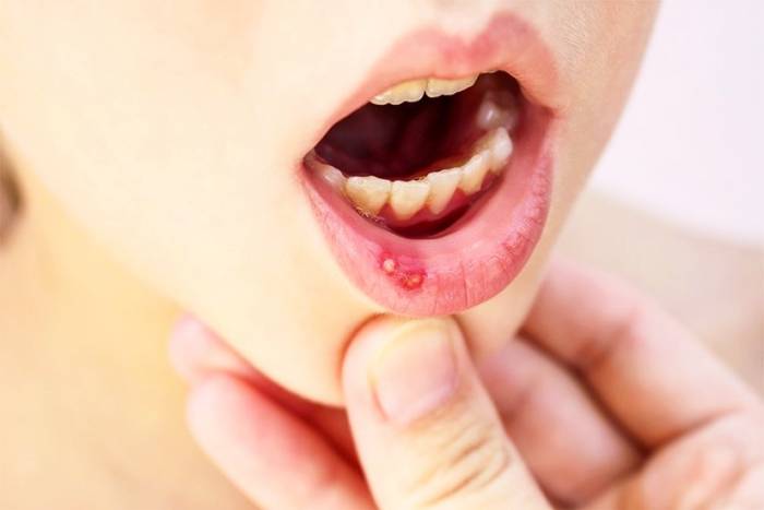 آفت دهان و زبان
