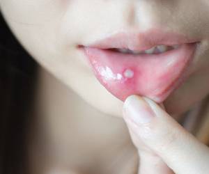 درمان قطعی و فوری آفت دهان+ علت مهم آفت دهان و زبان
