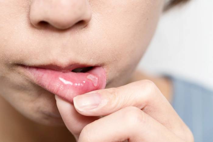 درمان سریع آفت دهان و زبان