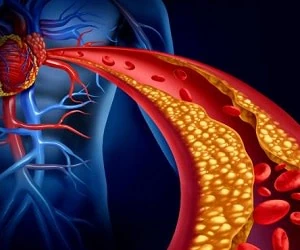 درمان چربی خون