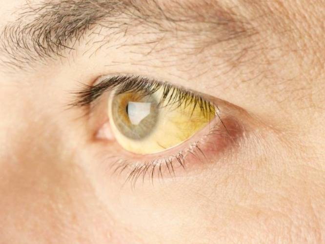 زرد شدن چشم