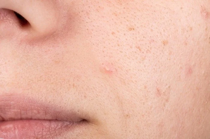 منافذ باز صورت