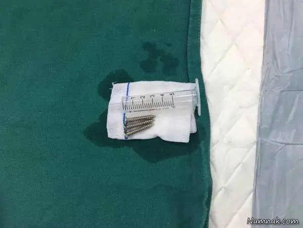 پیچ در معده
