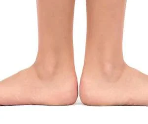 علت صافی کف پا
